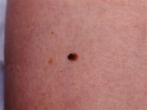 melanoma in situ recurrence